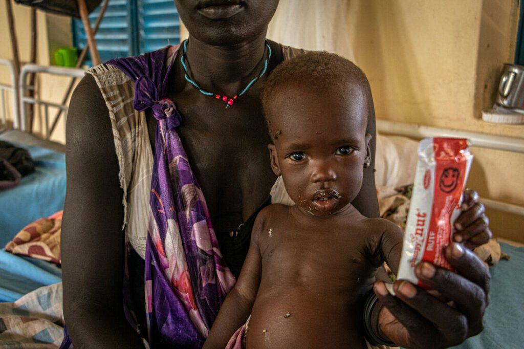 A malnourished child with therapeutic food in a stabilization centre.
